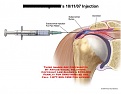 Click image for larger version

Name:	4fde41d4d88eef77d161a5bd39267a43--bursa-rheumatoid-arthritis.jpg
Views:	1337
Size:	28.5 KB
ID:	91389